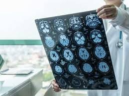 Hope on the Horizon: New Alzheimer's Drug Shows Unprecedented Success in Halting Cognitive Decline in Phase 3 Trials